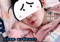 8岁女孩吃布洛芬过敏肿成香肠嘴 目前孩子无碍