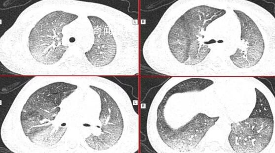 感染新冠会变白肺?医生:有年轻病例