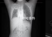 男孩咳嗽发热在家硬扛成白肺 目前的症状已经明显好转