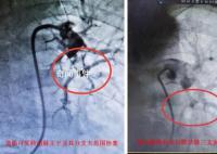 阳性一个月后肺栓塞风险增加33倍 一医生接连抢救两名患者都出现了胸闷胸痛症状