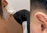 男子理发耳朵被剪掉一块肉 理发店只付了200元医药费