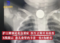 2岁娃咳嗽50天查出硬币卡喉 经手术取出了硬币