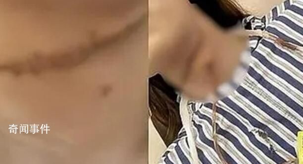 被丈夫割喉女子获发人身安全保护令 妇联：已介入事件