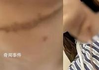 被丈夫割喉女子获发人身安全保护令 妇联：已介入事件