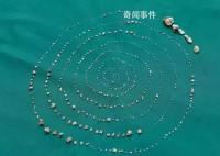 世界上牙齿最多的人是谁 印度男孩526颗牙齿图片大全