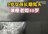 9岁女孩沉迷手机颈椎老如50岁 颈椎的弧度已经往反方向弯曲