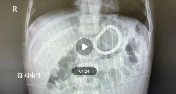 2岁幼童误吞28颗磁力珠 医院紧急救治