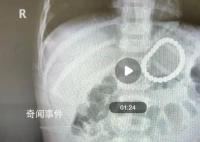 2岁幼童误吞28颗磁力珠 医院紧急救治