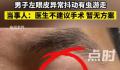 男子左眼皮异常抖动有虫游走 医生不建议手术