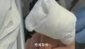 男孩啃秃10个指甲引发骨髓炎 目前孩子已转危为安
