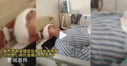 爸爸先后三次取头皮救重伤儿子 玩酒精兄弟俩被烧伤