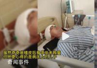 爸爸先后三次取头皮救重伤儿子 玩酒精兄弟俩被烧伤