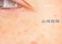 25岁女生长期熬夜长出老年斑 网友看后都心有戚戚焉