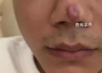 男子整形后称没法靠颜值吃饭了 现在没法继续工作了