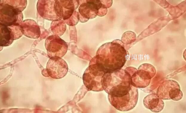 致命真菌在美国蔓延 近一半感染者90天内死亡