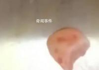 女子摔跤牙磕进嘴唇1月才发现 上嘴唇没有消肿摸的时候还有硬物
