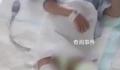 5岁男童被生母虐待致截肢 妇联回应