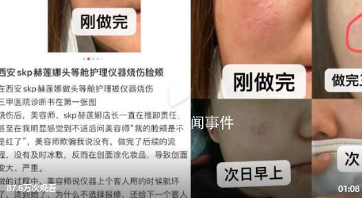 网友曝在赫莲娜做护理致脸部烧伤 因仪器有损坏和美容师操作不当