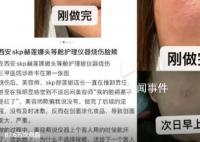 网友曝在赫莲娜做护理致脸部烧伤 因仪器有损坏和美容师操作不当