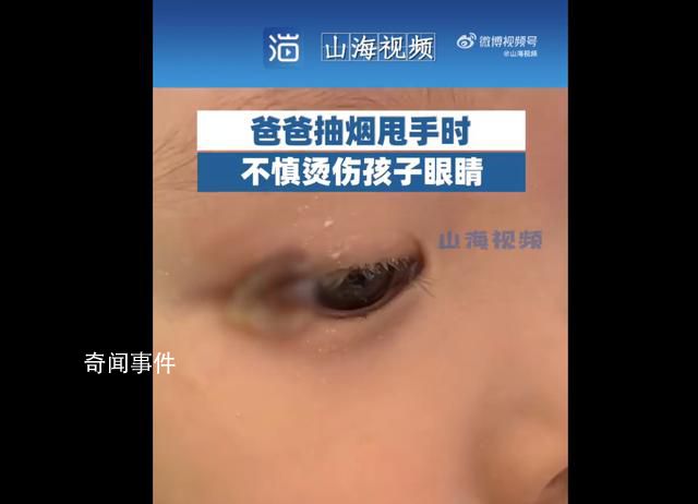 爸爸甩烟不慎致孩子眼角烫伤 引发网友热议