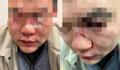 中国男子在伦敦遇袭 被打至眼眶骨折