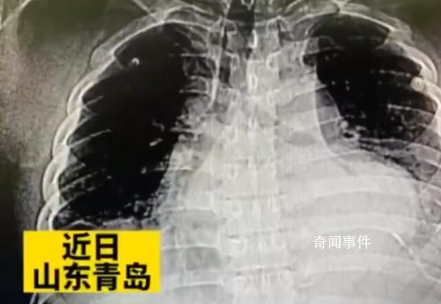 男子头疼自己在家针灸扎破心脏 目前患者生命体征稳定