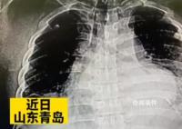 男子头疼自己在家针灸扎破心脏 目前患者生命体征稳定