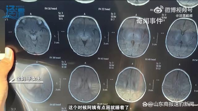 月嫂拍嗝时打盹致婴儿头顶骨骨折 治疗后医生建议半年内观察情况并复查