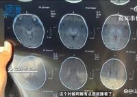月嫂拍嗝时打盹致婴儿头顶骨骨折 治疗后医生建议半年内观察情况并复查