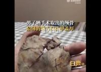 男子术后晒颅骨碎片:最薄处像指甲