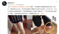 女子骨折做手术后左腿变长2.3厘米 经医疗鉴定为伤残10级