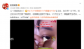 女子3千割眼袋3个月眼睛闭不合 一洗脸就进水