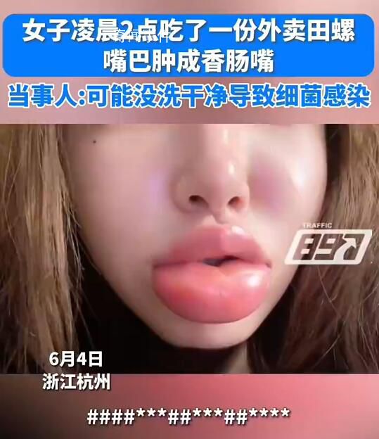 女生半夜嗦田螺肿成香肠嘴 吃了两天的消炎药目前已经消肿了