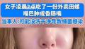 女生半夜嗦田螺肿成香肠嘴 吃了两天的消炎药目前已经消肿了