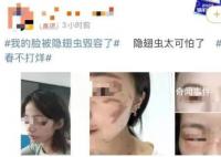 隐翅虫的毒液堪比硫酸 隐翅虫咬后皮肤溃烂几天能够好