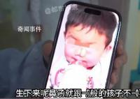 3岁男孩患象鼻病全球仅34例 象鼻病是什么病