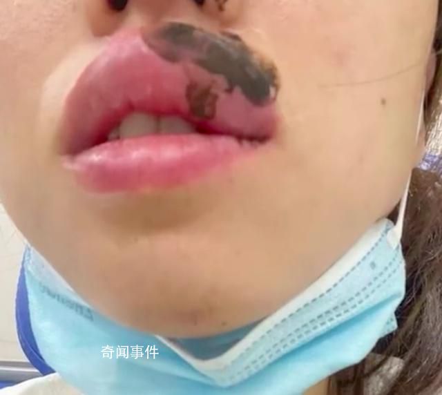 女子睡觉被蜈蚣咬醒 嘴肿成“香肠”