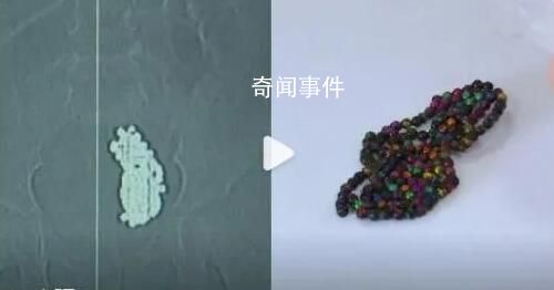 女童吞下上百颗磁力珠肠道如鱼籽 家长在看护时需谨慎
