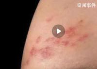 新冠后得带状疱疹的人变多了?