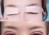 女子不满意双眼皮手术 要求枪毙医生