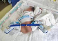 家属称剖宫产时孩子大腿被掰骨折 医生已停职