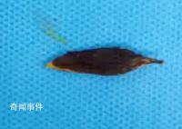 男子吃粽子误吞枣核致小肠穿孔 医院已收治不少误吞枣核的患者