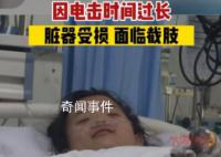女孩充电被电击内脏受损面临截肢 身上多处受伤