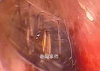 蜘蛛在男子睡梦时钻入耳道结网 网友：看着就疼