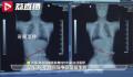 仅3周接诊5名下腰瘫痪孩子 背后真相令人震惊