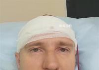 男子为控制梦境给脑袋钻孔 失血近1升险些丧命