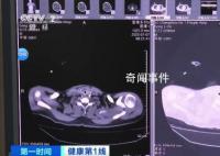 36岁男子吹空调住进ICU 如何预防空调病