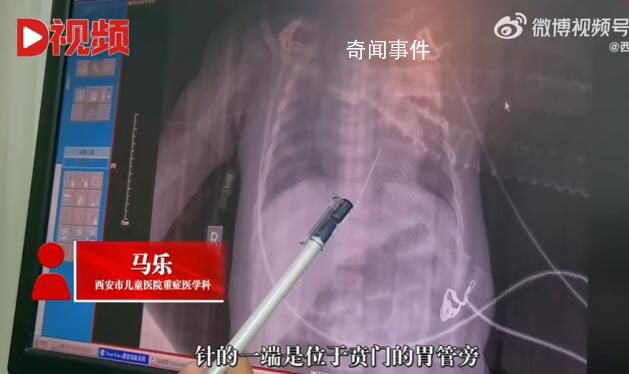 女婴心脏扎进一根4厘米绣花针 患儿目前在PICU进行康复治疗