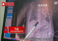 女婴心脏扎进一根4厘米绣花针 患儿目前在PICU进行康复治疗