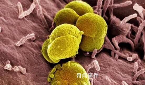 小伙使用酒店毛巾后被确诊淋病 出现流泪尿痛症状